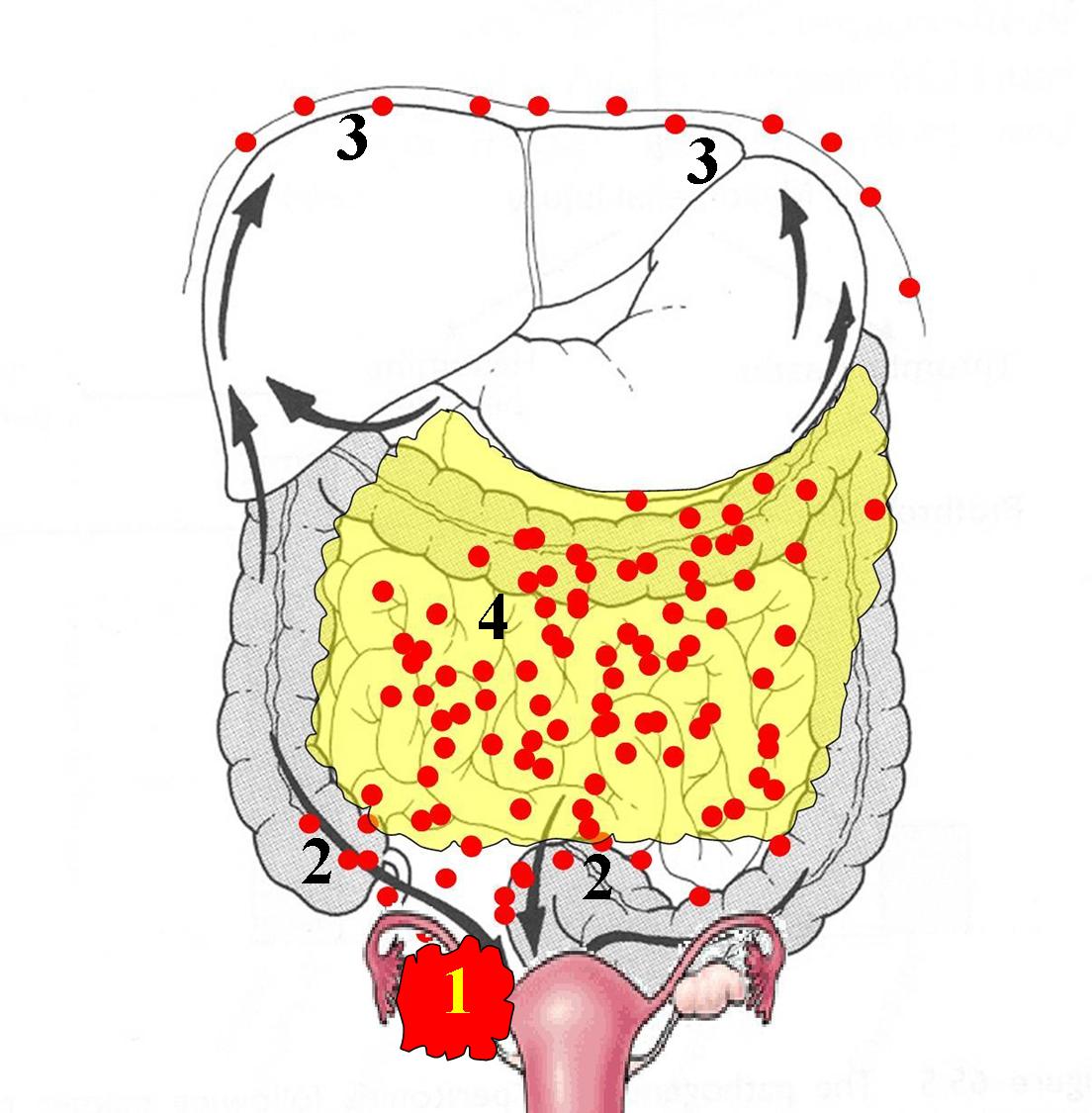 HIPEC OVHIPEC chemotherapy ovarian cancer of the ovary